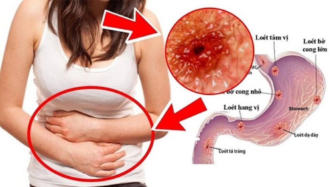 Bệnh lý viêm loét dạ dày tá tràng: Nguyên nhân, dấu hiệu cảnh báo