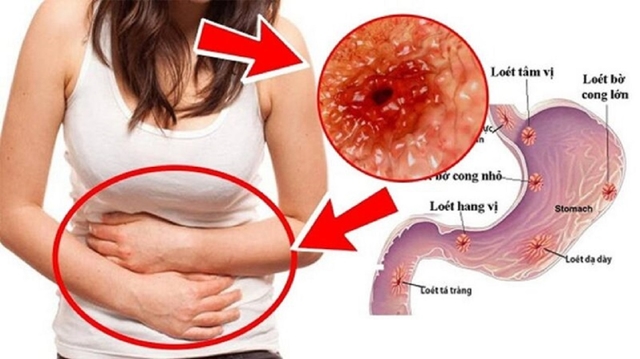 Bệnh lý viêm loét dạ dày tá tràng: Nguyên nhân, dấu hiệu cảnh báo
