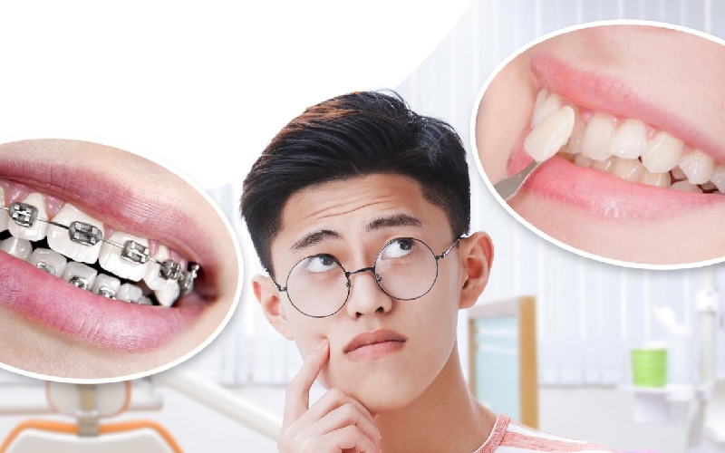 tầm 20 tuổi Nên niềng răng hay bọc sứ