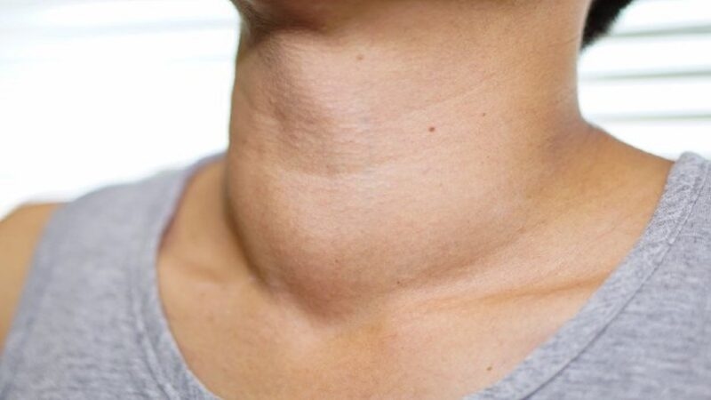 Nguyên nhân gây cường giáp, triệu chứng và biến chứng