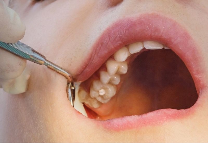 Thủ thuật nhổ răng hàm trên cần đúng quy trình để tránh rủi ro.