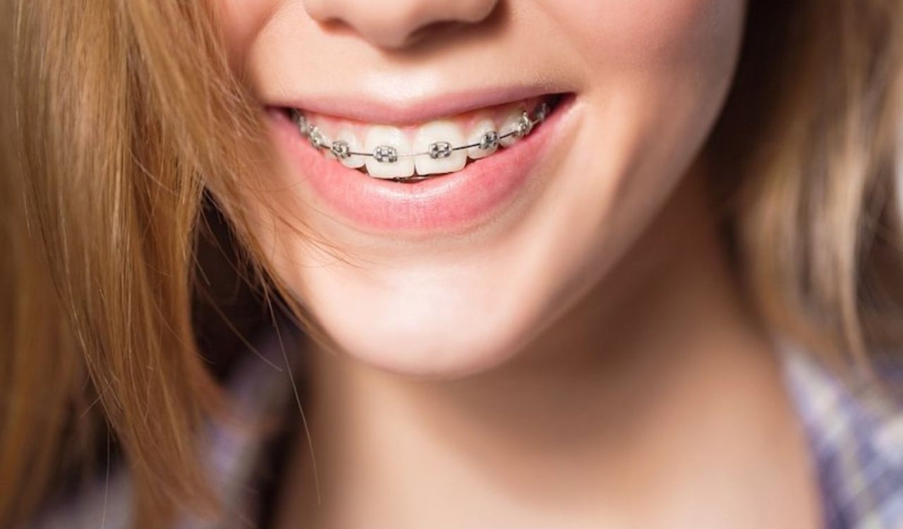 5 Ưu điểm vượt trội của niềng răng kim loại bạn nên biết