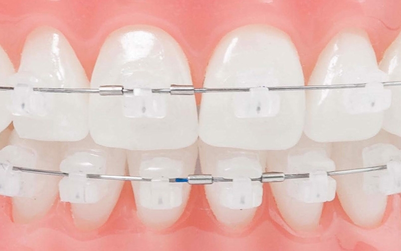 Niềng răng mắc cài sứ như thế nào