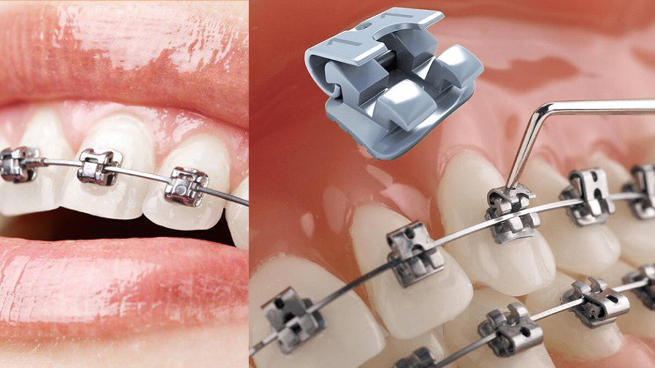 Niềng răng mắc cài tự buộc &#8211; Đối tượng, quy trình và lưu ý