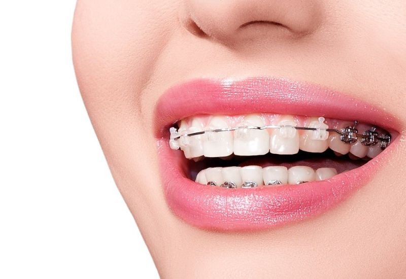 Niềng răng mọc lệch giúp điều chỉnh hàm răng đều đẹp và hỗ trợ ăn nhai tốt hơn.