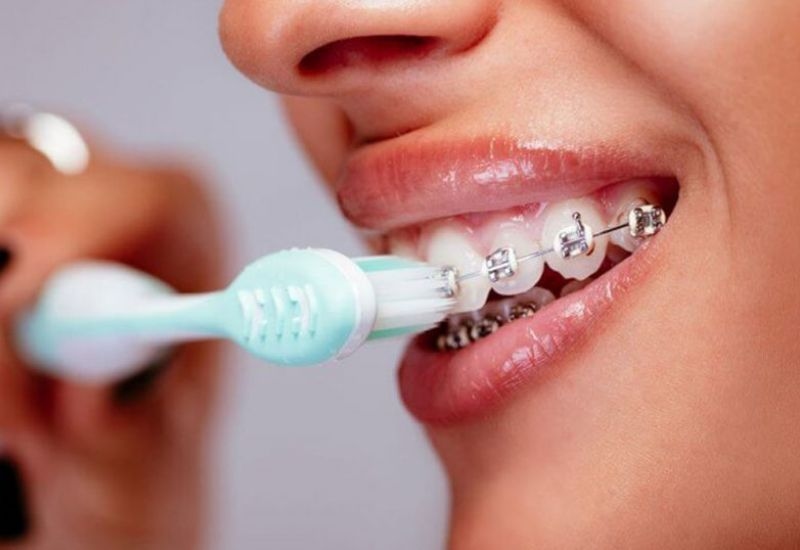 Chăm sóc sau niềng đúng cách giúp kết quả điều trị đạt hiệu quả tối ưu và giữ vững theo thời gian.