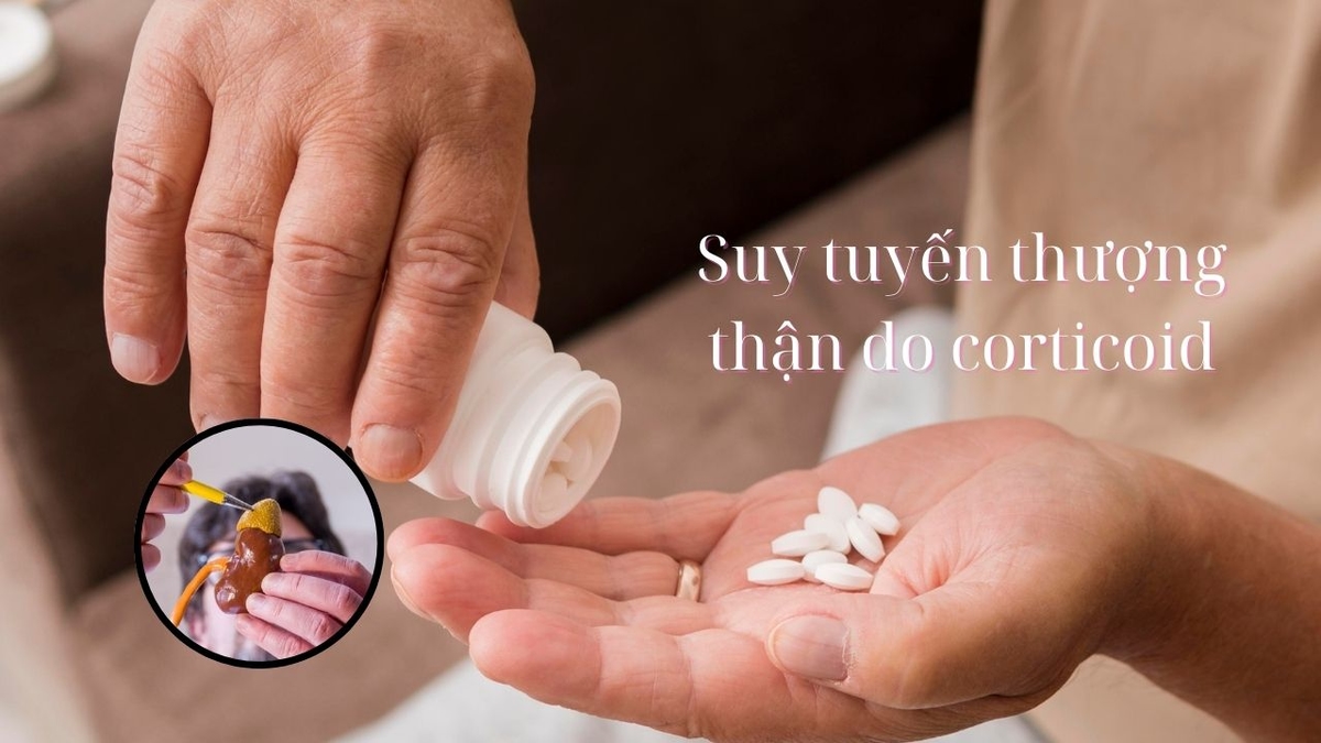 Suy tuyến thượng thận do corticoid: Hiểm họa tiềm ẩn từ thuốc quen thuộc
