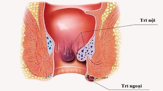 Cách nhận biết sự khác nhau giữa trĩ nội và trĩ ngoại
