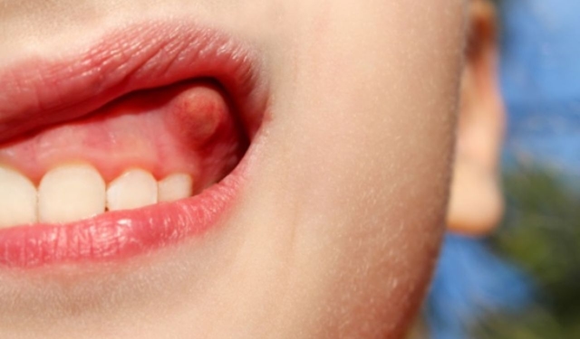 Trị sưng lợi ở trẻ em: Những điều cha mẹ cần lưu ý