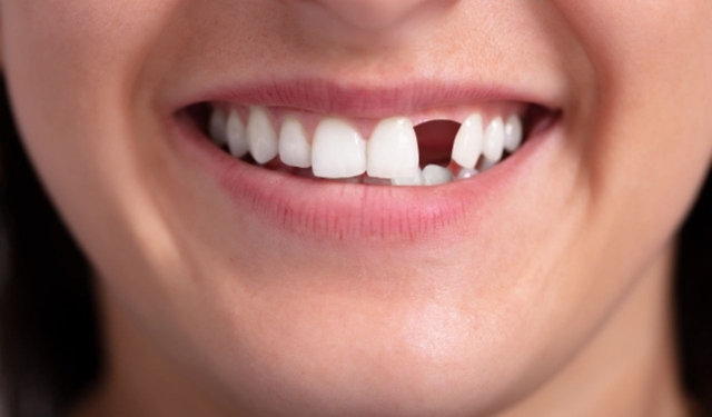 Để hiệu quả tối ưu sau khi trồng răng cửa: Những lưu ý quan trọng