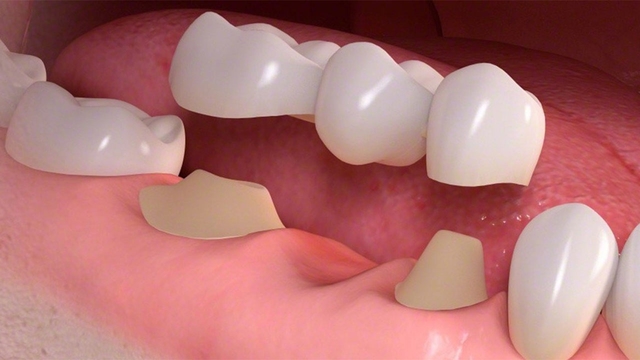 Trồng răng sứ là gì? Lợi ích và quy trình chuẩn y khoa bạn cần biết