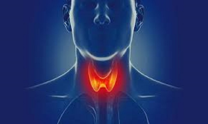 Đây là biến chứng hiếm nhưng cực kỳ nguy hiểm, xảy ra khi hormone tuyến giáp tăng vọt đột ngột