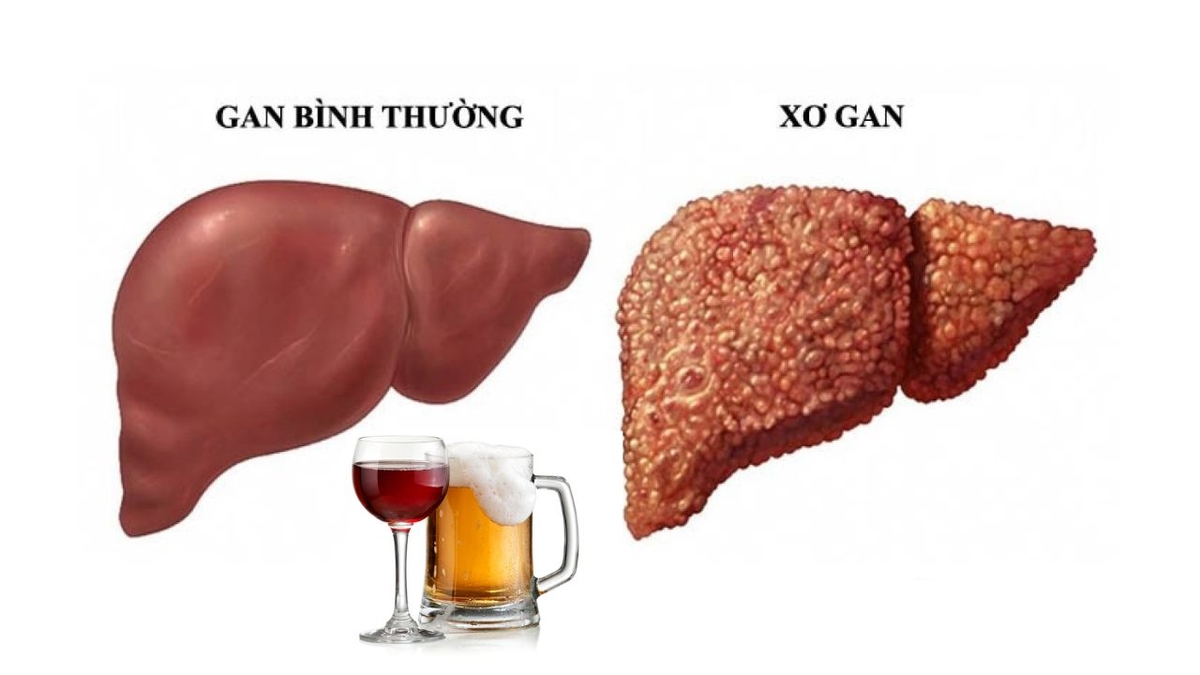 Sự nguy hiểm của xơ gan do rượu và cách phòng tránh