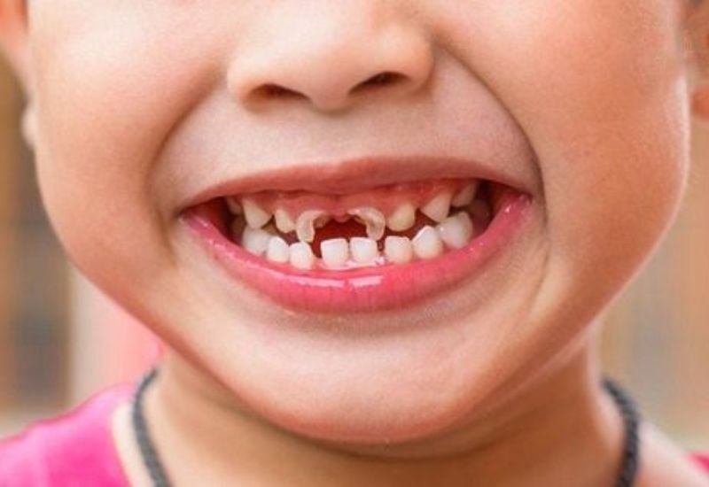 Bé sâu răng sữa thường do chăm sóc răng miệng chưa đúng cách.