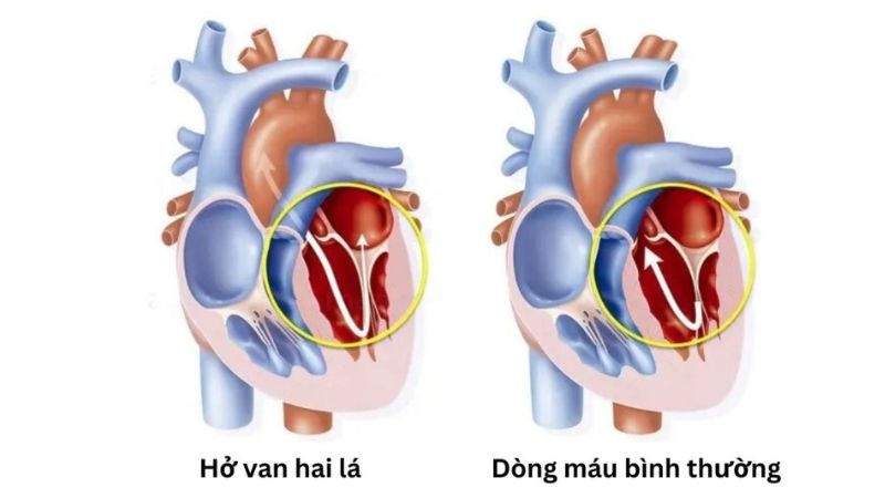 Bệnh hở van tim 2 lá là gì?