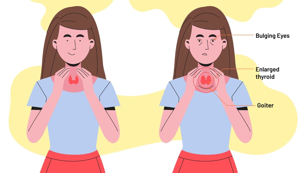 Cường giáp có nguy hiểm không và các trường hợp cần lưu ý