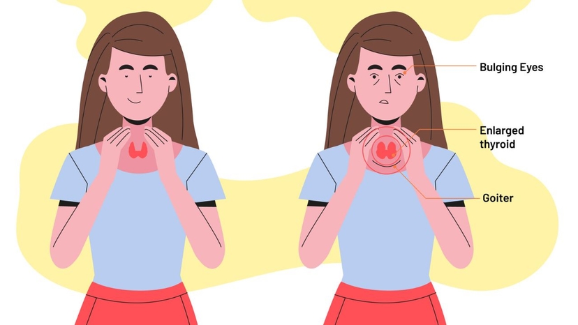 Cường giáp có nguy hiểm không và các trường hợp cần lưu ý