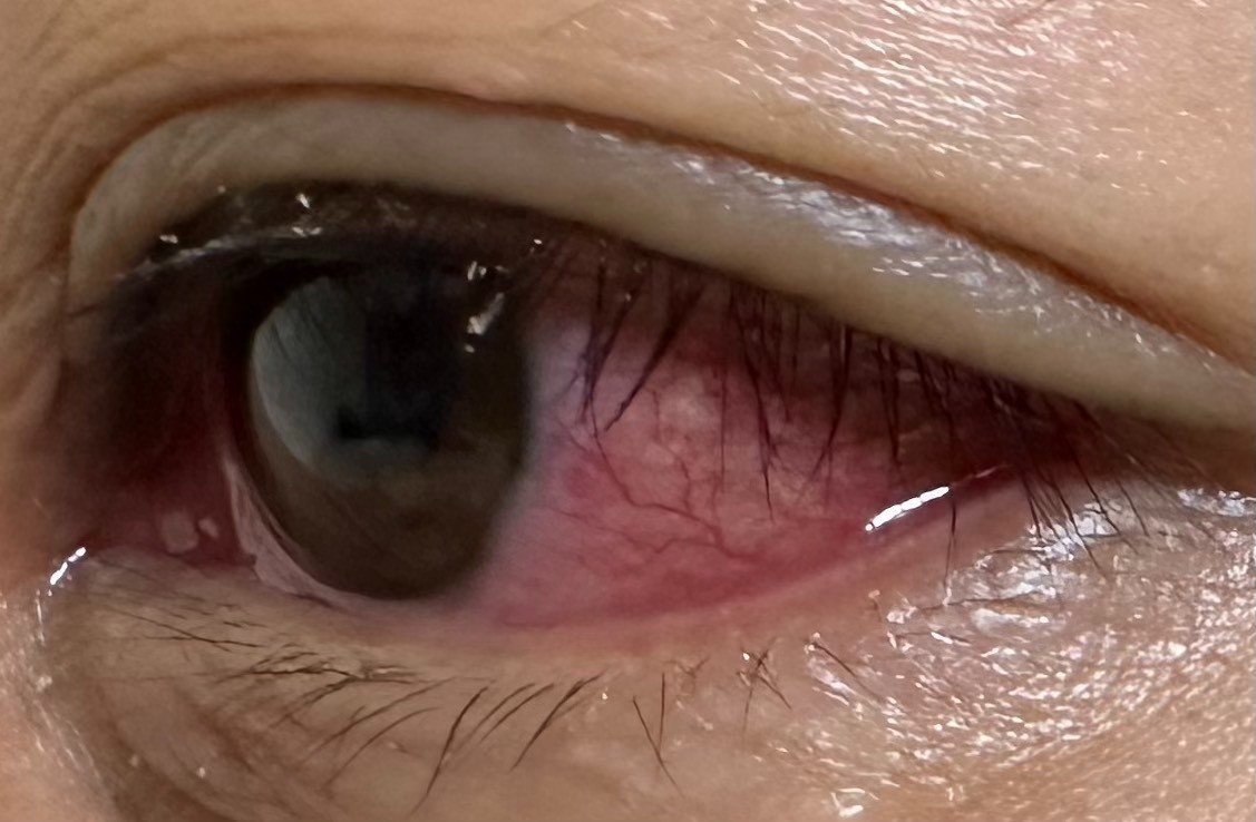 Đau mắt đỏ có thể do nhiều nguyên nhân như vi khuẩn, virus hoặc dị ứng.