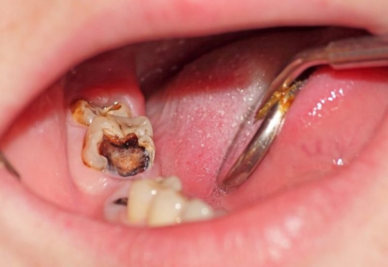 Khi xuất hiện dấu hiệu đau sâu răng, hãy nhanh chóng đến nha khoa để được điều trị, tránh nguy cơ nhiễm trùng lan rộng