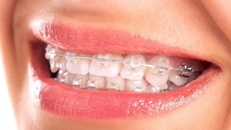 Đeo niềng răng trong bao lâu &#8211; Những điều cần chú ý