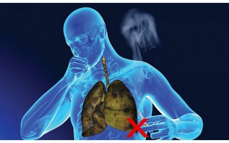 Hút thuốc lá Là yếu tố nguy cơ hàng đầu dẫn đến bệnh suy hô hấp mãn tính