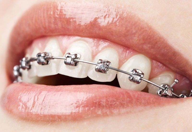 Niềng răng khấp khểnh giúp nắn chỉnh răng lệch, chen chúc, cải thiện thẩm mỹ và ăn nhai.