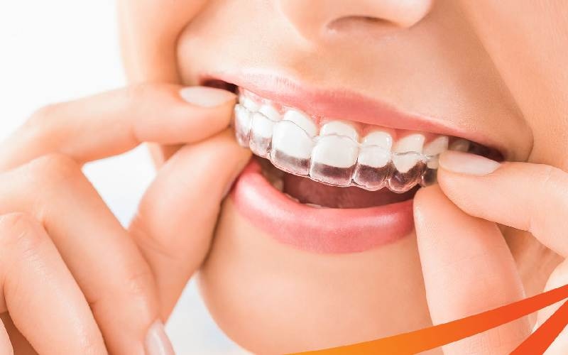 Niềng răng trong suốt Invisalign là gì