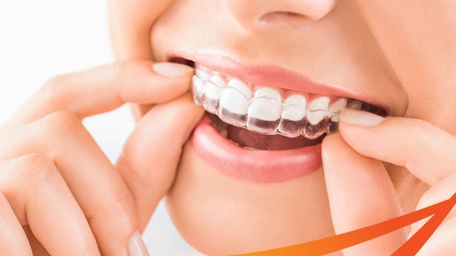 Niềng răng trong suốt Invisalign &#8211; Những điều nên biết sớm