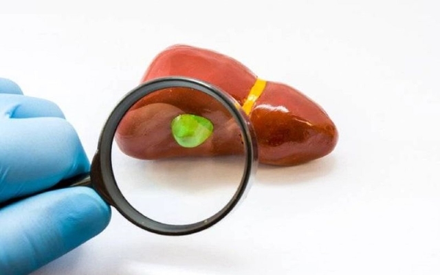 Phẫu thuật túi mật: Khi nào cần thực hiện và liệu có nguy hiểm?