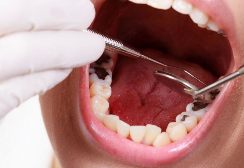 Tình trạng răng bị sâu kéo dài có thể gây tổn hại nghiêm trọng đến sức khỏe răng miệng tổng thể.