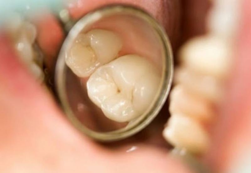 Nhận biết răng sâu nhẹ có thể gặp khó khăn nếu bạn bỏ qua những dấu hiệu ban đầu.