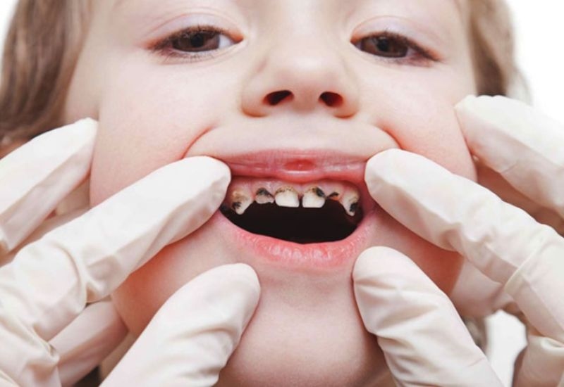 Sâu răng ở trẻ em hiện đang là một trong những vấn đề sức khỏe răng miệng khiến nhiều phụ huynh lo lắng.