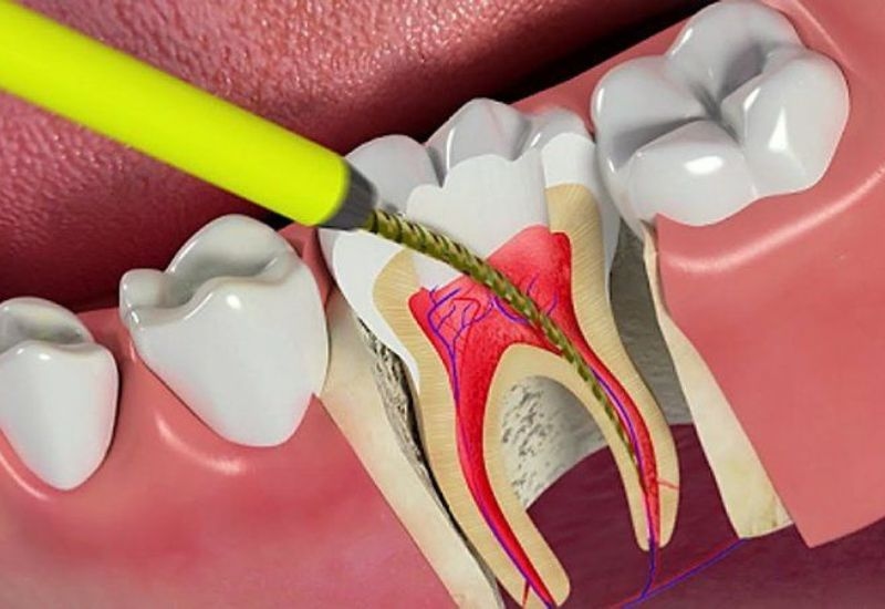 Sâu răng viêm tủy xảy ra khi vi khuẩn xâm nhập đến buồng tủy gây viêm.