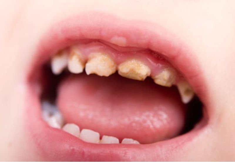 Tình trạng trẻ em sâu răng kéo dài mà không điều trị đúng cách sẽ ảnh hưởng không nhỏ đến sức khỏe răng miệng về lâu dài.