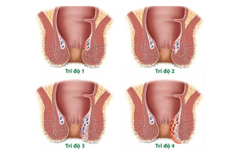 Trĩ nội được chia thành 4 cấp độ rõ ràng theo sự tiến triển và sa ra ngoài của búi trĩ. 