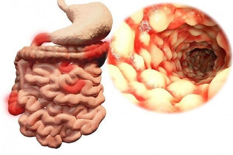 triệu chứng bệnh crohn