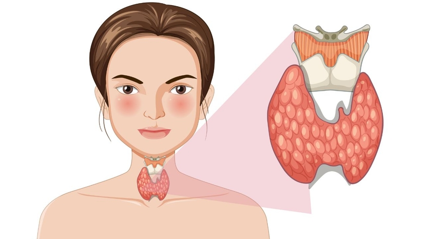 Triệu chứng cường giáp trên lâm sàng và chẩn đoán y khoa