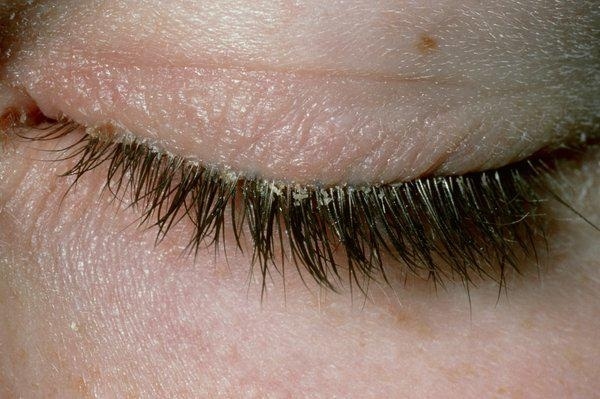 Viêm bờ mi có vảy, hay còn gọi là viêm bờ mi trước, là một dạng viêm bờ mi đặc trưng bởi sự xuất hiện của các vảy khô, bong tróc bám quanh chân lông mi.
