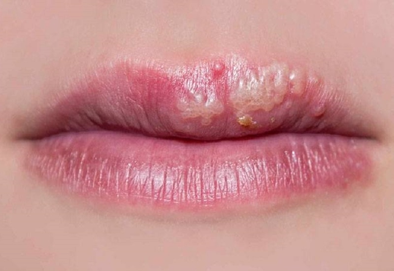 Bệnh mụn rộp herpes ở môi là gì? Có nguy hiểm không