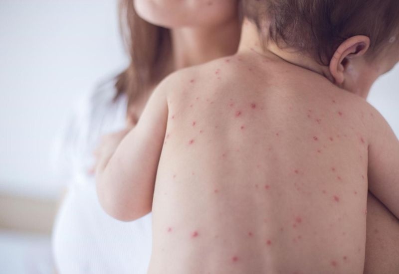 Bị thủy đậu có được ăn cà chua không - Thủy đậu là bệnh truyền nhiễm do virus varicella-zoster gây ra, thường khiến người bệnh sốt, mệt mỏi và nổi nốt phỏng khắp cơ thể.