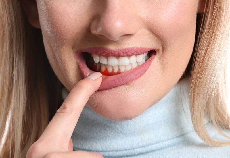 Người bị viêm nha chu thường có biểu hiện nướu sưng đỏ, dễ chảy máu khi đánh răng hoặc ăn nhai.