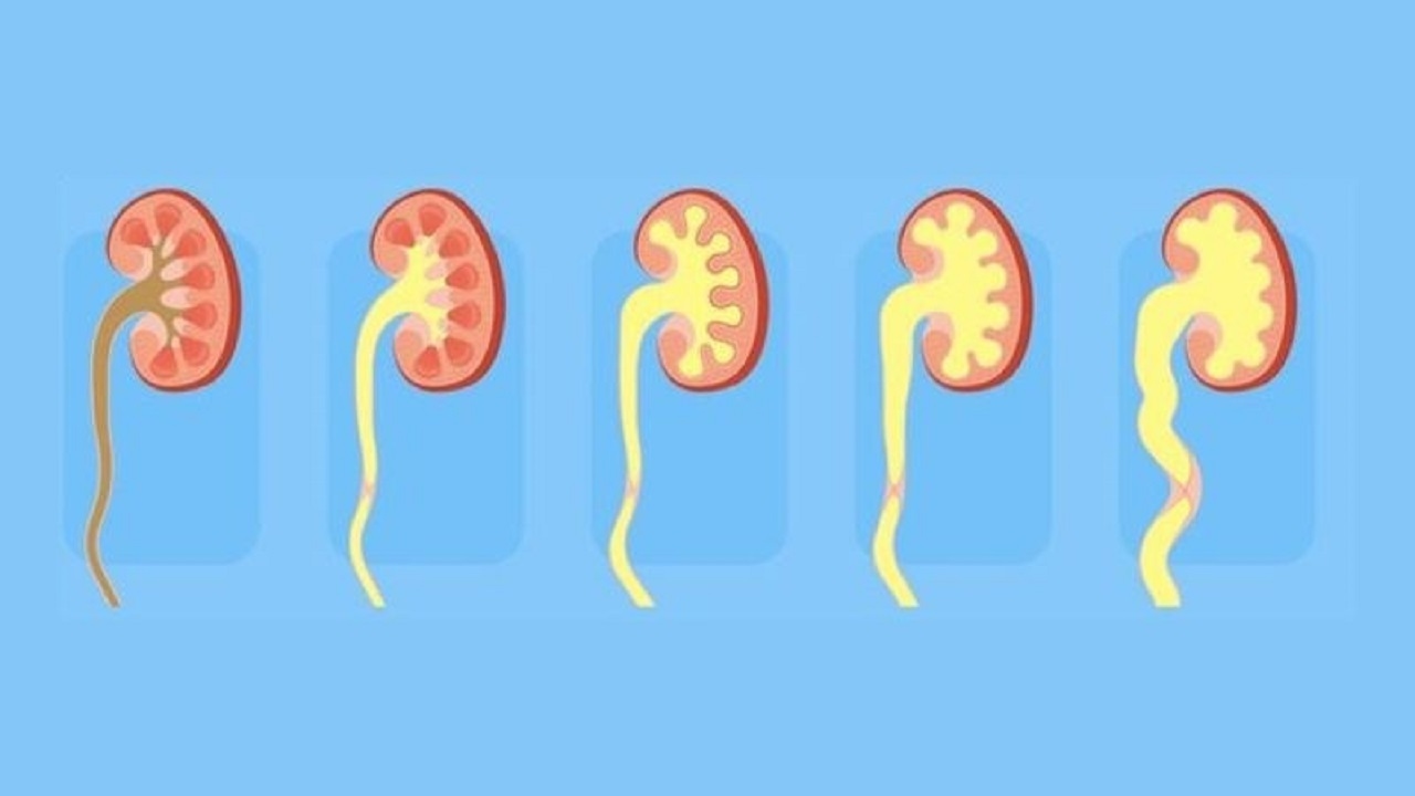 biến chứng của thận ứ nước