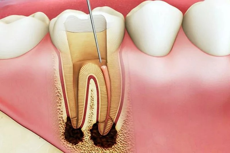Bọc răng sứ có phải diệt tủy không
