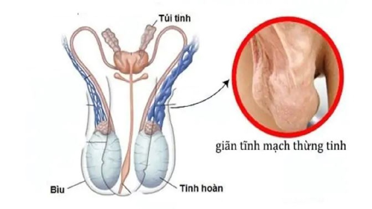 Giãn tĩnh mạch thừng tinh là tình trạng các tĩnh mạch trong đám rối phía trên tinh hoàn bị giãn nở và xoắn bất thường