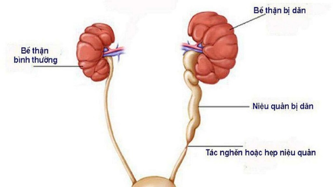 Chế độ dinh dưỡng có ảnh hưởng trực tiếp đến tiến triển của bệnh giãn đài bể thận