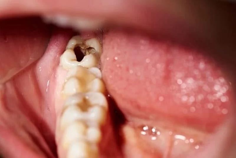 Nhổ hai răng sâu cùng lúc có nguy hiểm không?