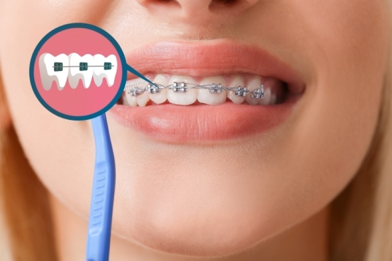 Niềng răng hô nhẹ là phương pháp hiệu quả và cần thiết 