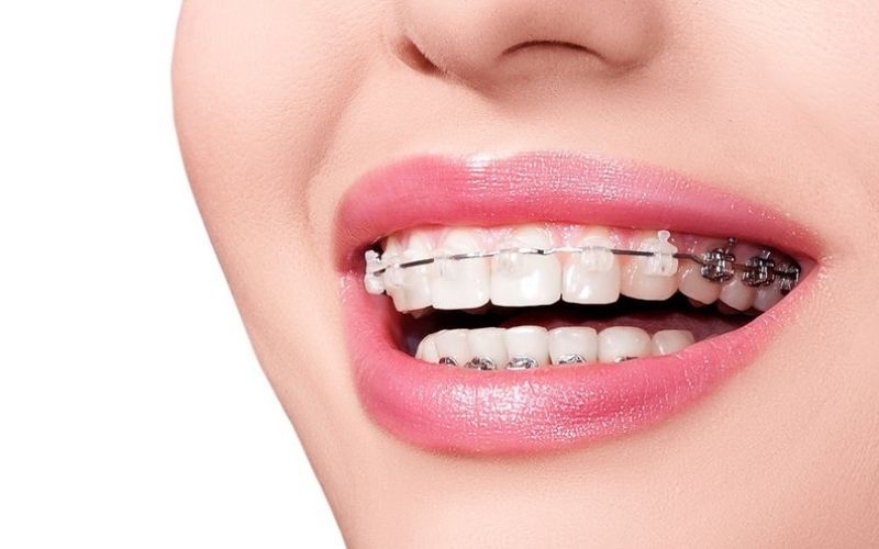Niềng răng không cần nhổ có đảm bảo kết quả thẩm mỹ tuyệt đối không