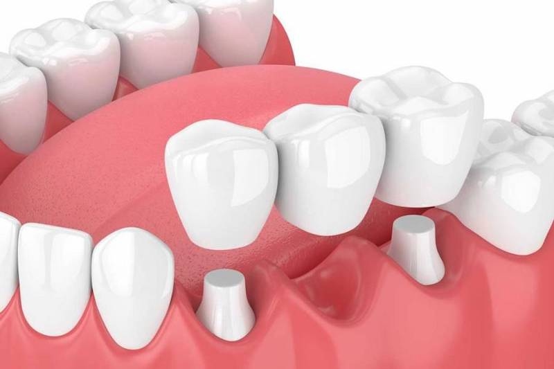 Phục hình cầu răng và những lưu ý quan trọng 