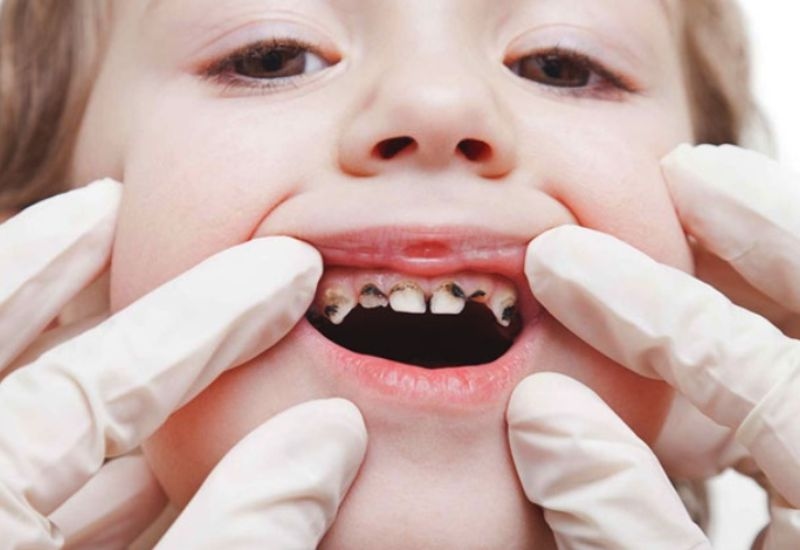 Răng bị sâu ăn thường biểu hiện bằng các vệt trắng hoặc mảng nâu đen trên bề mặt răng.